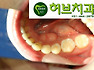 충치치료가격_10년전레진가격행사로 작은충치는 간단히 레진치료로