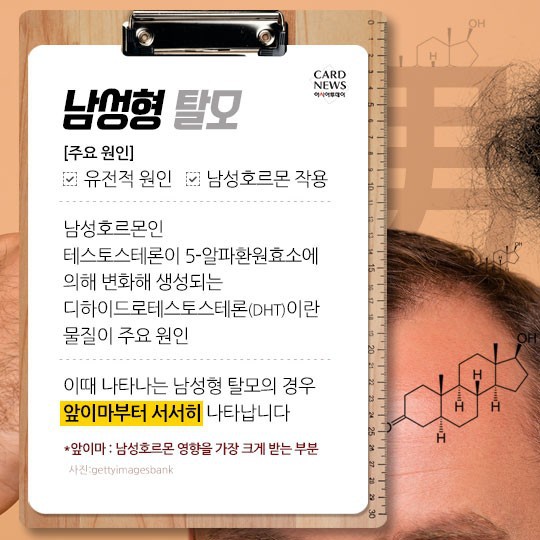 [카드뉴스] “소중한 머리카락 왜 자꾸 빠질까?”... 탈모 원인 및 치료법? 